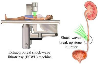 Extracorporeal-shock-wave-lithotripsy