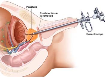 prostate surgery chennai