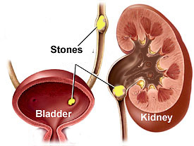 urinary stone