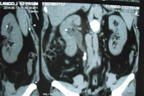 CT scan Showing Stone in Right Kidney and Ureter