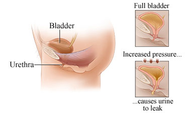 urinary icontinence treatment chennai