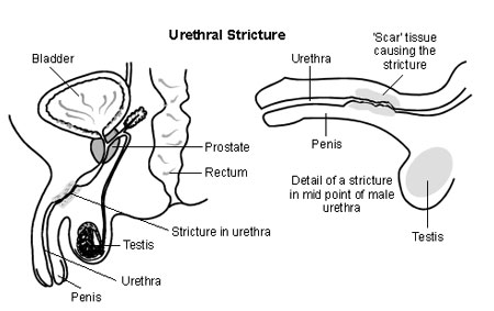 urethral stricture treatment chennai
