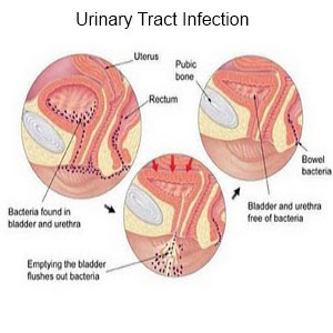 urinary tract infection treatment chennai